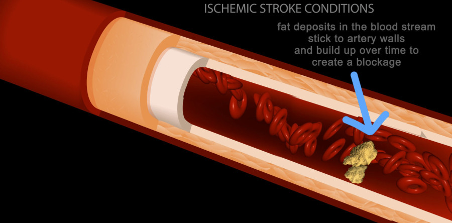 Infographics: Stroke